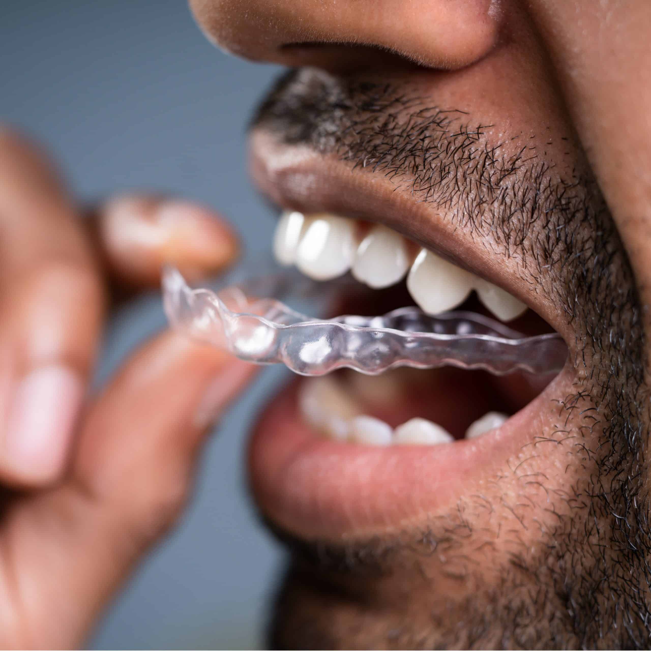 Close up of a man putting in a suresmile clear dental aligner from martin family orthodontics