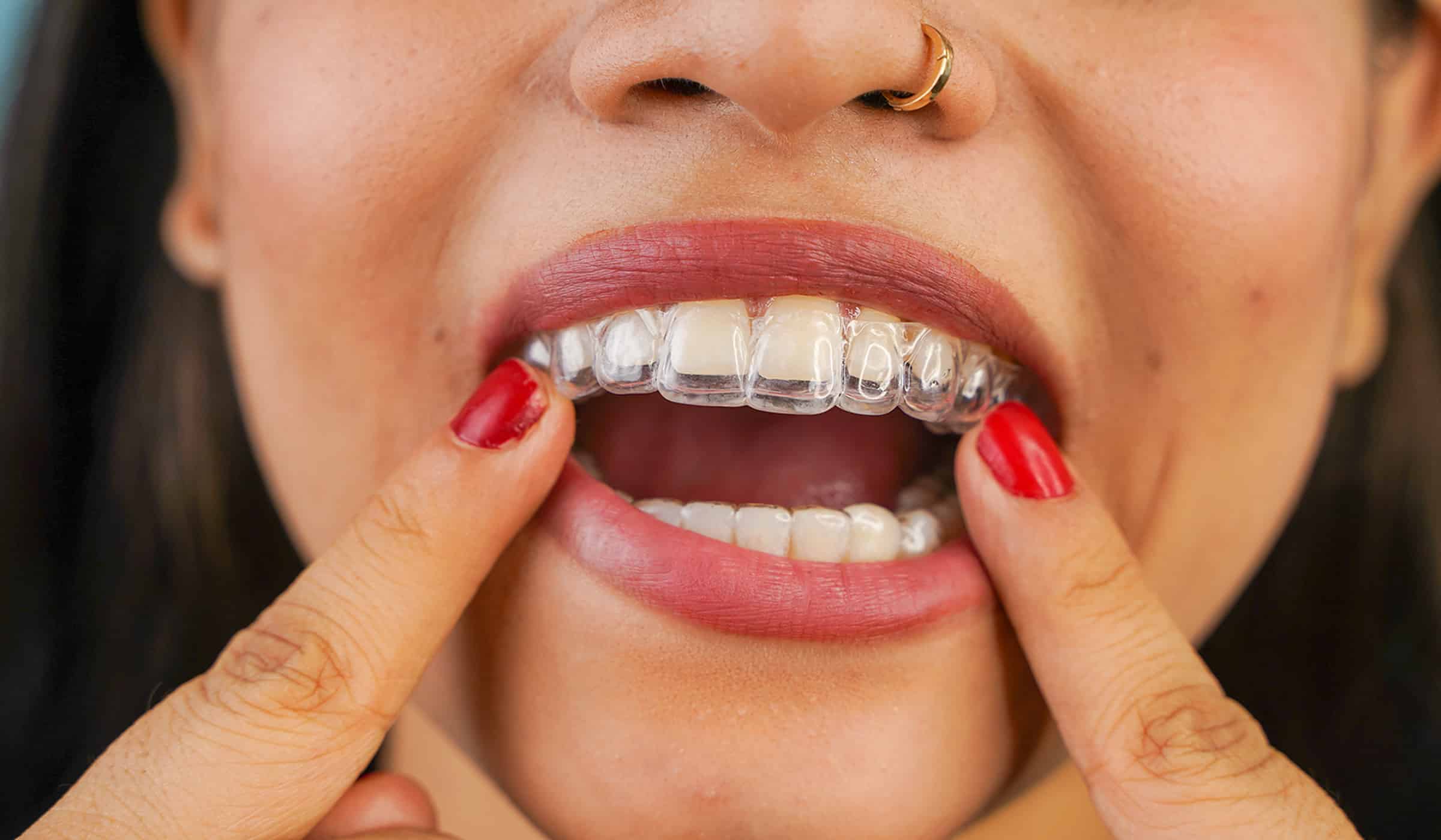 Woman getting clear dental aligners at the dentist in West Reading, PA