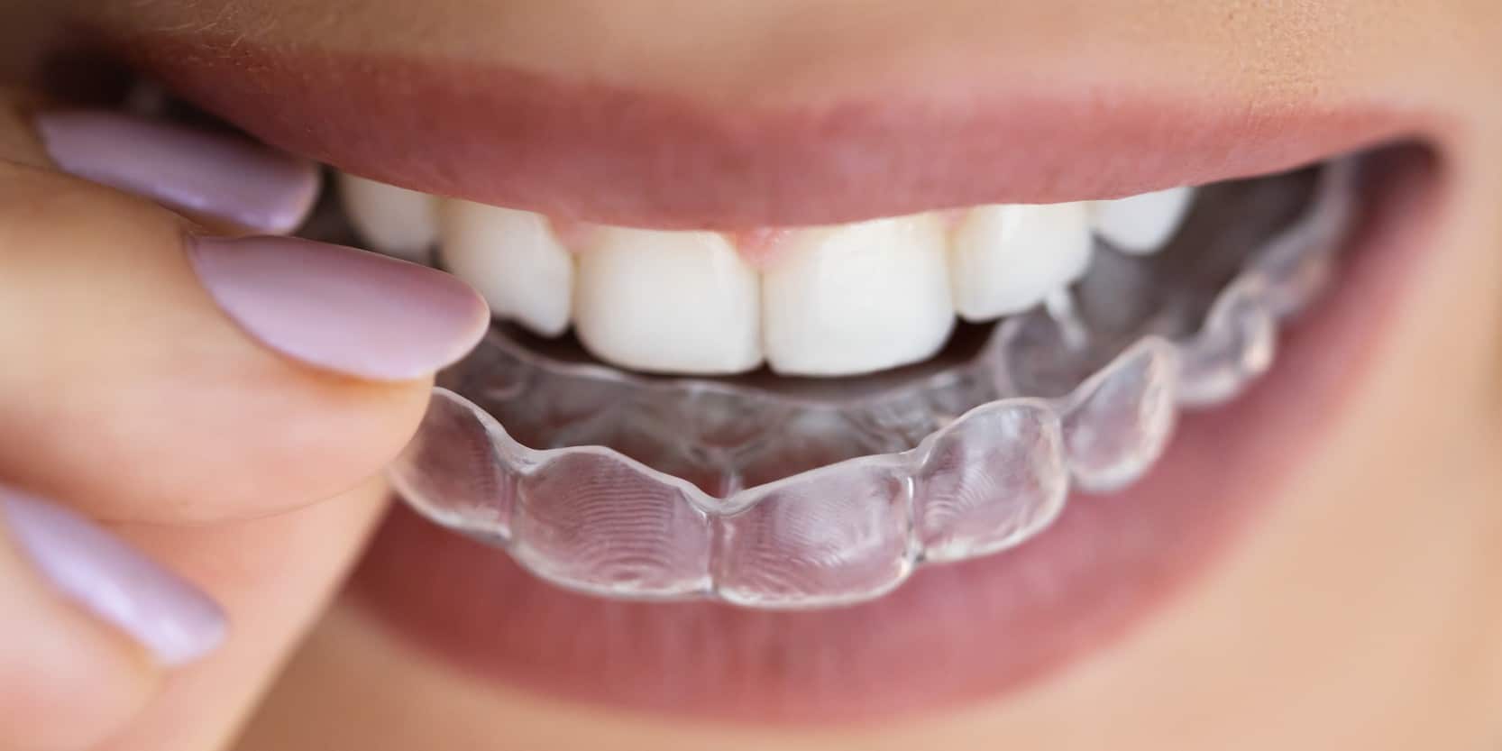 Ulab clear aligners at Martin Fmily Orthodontics in Reading PA