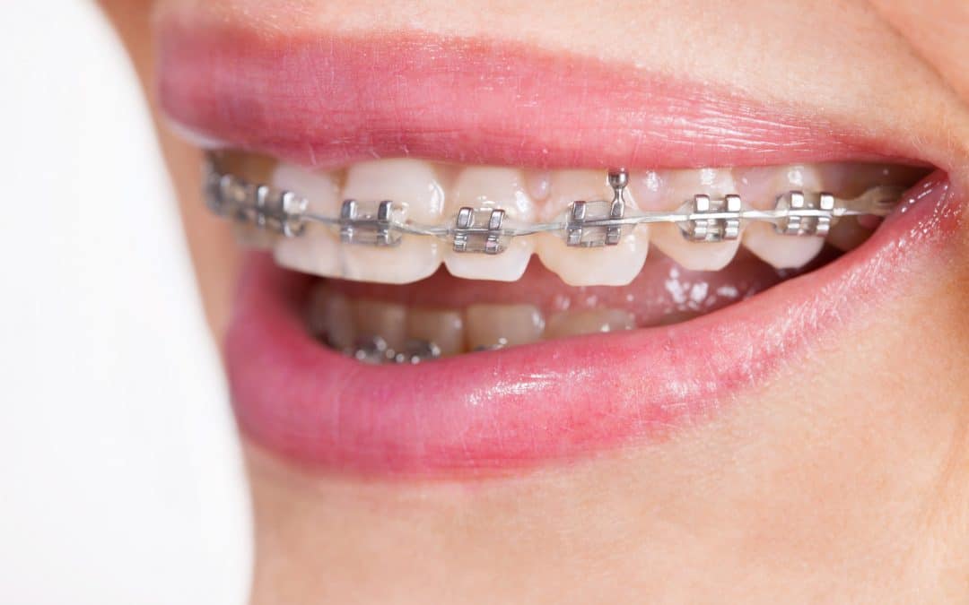 Can Orthodontic Treatment Fix an Overbite or Underbite?